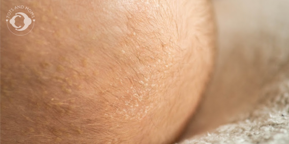 Cradle Crap In Babies What is Cradle Crap How does Cradle Crap occur Why Do Cradle Crap Occur Causes of Cradle Crap Reasons for Cradle Crap Remedies for Cradle Crap in Infants and babies